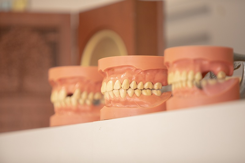 歯が3本以上抜けた場合から利用できる“コンフォートコネクト”